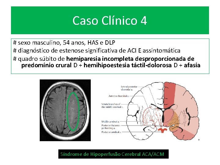 Caso Clínico 4 # sexo masculino, 54 anos, HAS e DLP # diagnóstico de