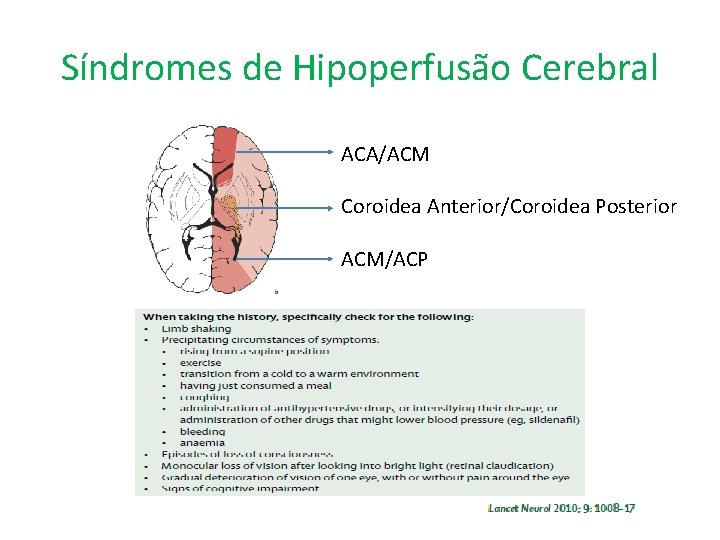 Síndromes de Hipoperfusão Cerebral ACA/ACM Coroidea Anterior/Coroidea Posterior ACM/ACP 