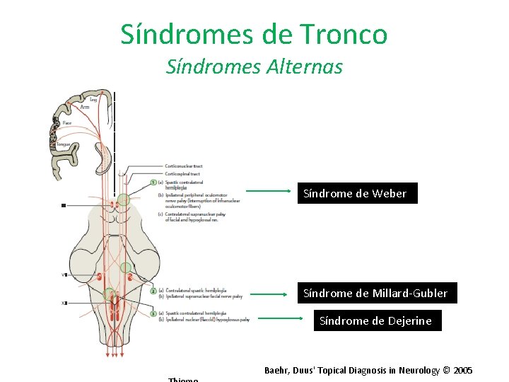 Síndromes de Tronco Síndromes Alternas Síndrome de Weber Síndrome de Millard-Gubler Síndrome de Dejerine
