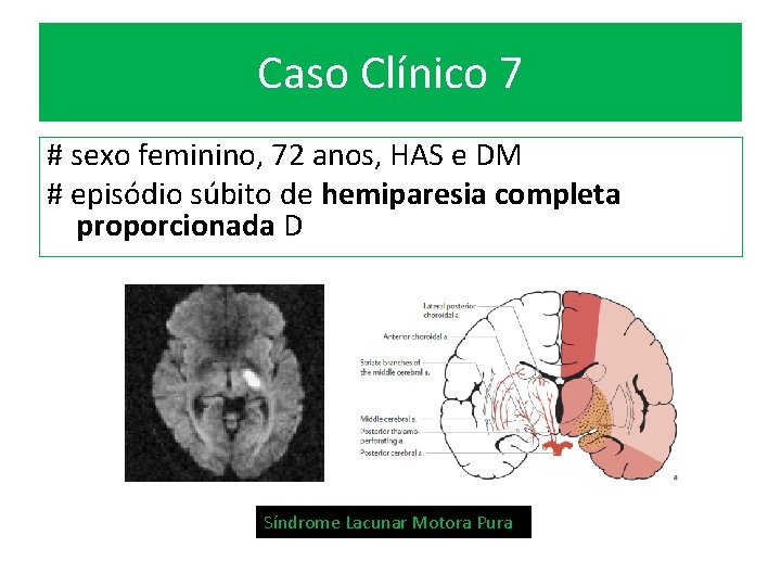 Caso Clínico 7 # sexo feminino, 72 anos, HAS e DM # episódio súbito