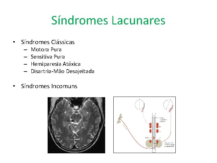 Síndromes Lacunares • Síndromes Clássicas – – Motora Pura Sensitiva Pura Hemiparesia Atáxica Disartria-Mão