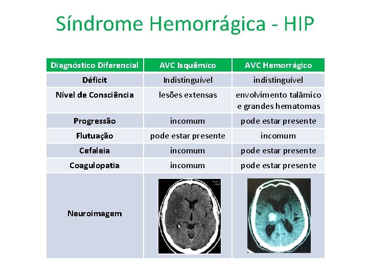 Síndrome Hemorrágica - HIP Diagnóstico Diferencial AVC Isquêmico AVC Hemorrágico Déficit Indistinguível indistinguível Nível