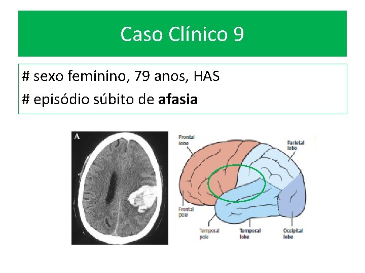 Caso Clínico 9 # sexo feminino, 79 anos, HAS # episódio súbito de afasia