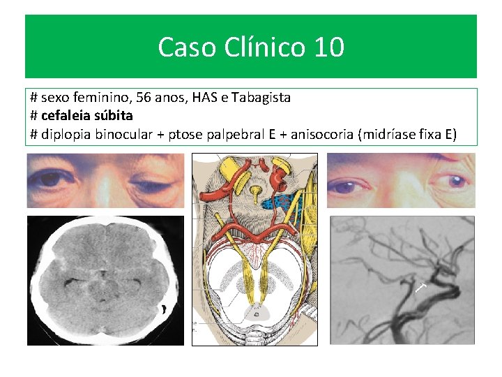 Caso Clínico 10 # sexo feminino, 56 anos, HAS e Tabagista # cefaleia súbita