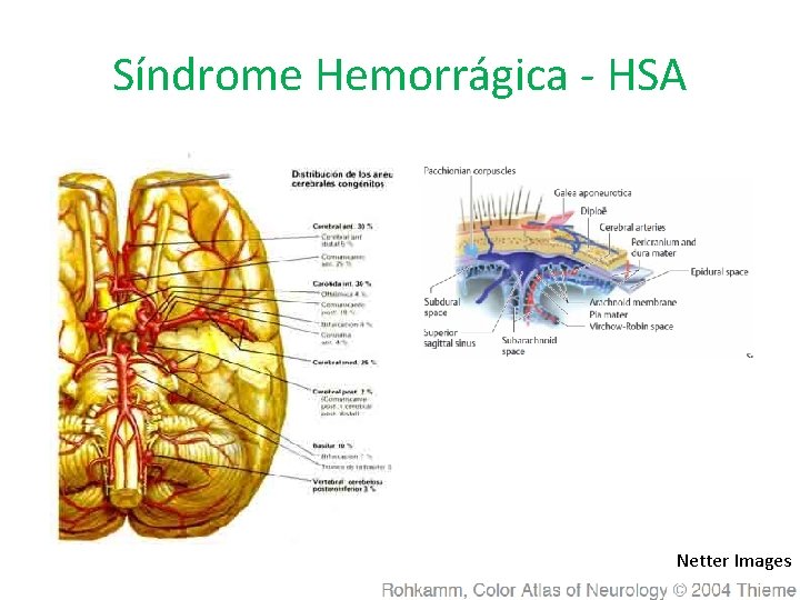 Síndrome Hemorrágica - HSA Netter Images 