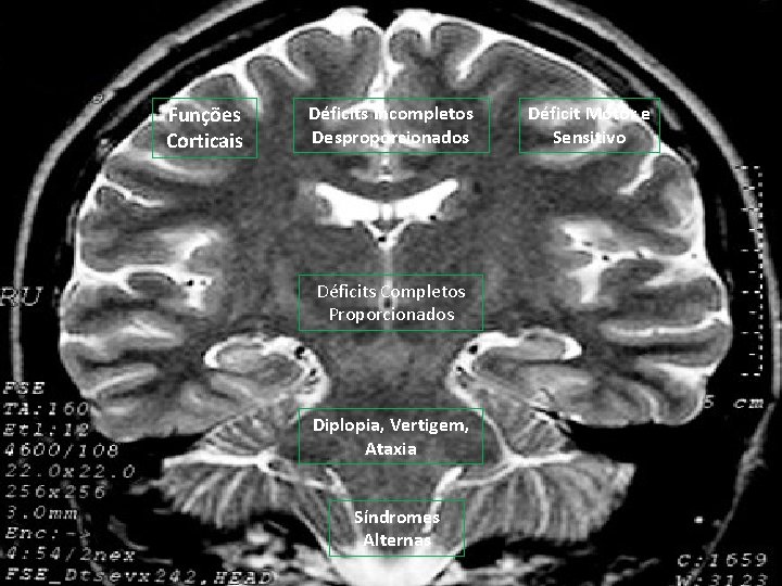 Funções Corticais Déficits Incompletos Desproporcionados Déficits Completos Proporcionados Diplopia, Vertigem, Ataxia Síndromes Alternas Déficit