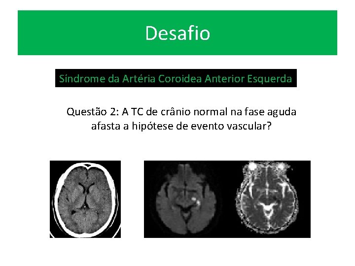 Desafio Síndrome da Artéria Coroidea Anterior Esquerda Questão 2: A TC de crânio normal