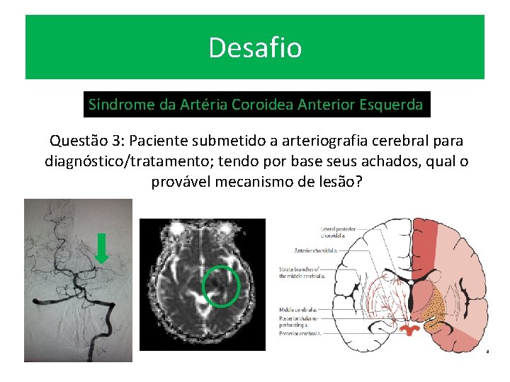 Desafio Síndrome da Artéria Coroidea Anterior Esquerda Questão 3: Paciente submetido a arteriografia cerebral