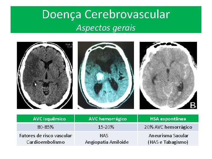 Doença Cerebrovascular Aspectos gerais AVC isquêmico AVC hemorrágico HSA espontânea 80 -85% 15 -20%