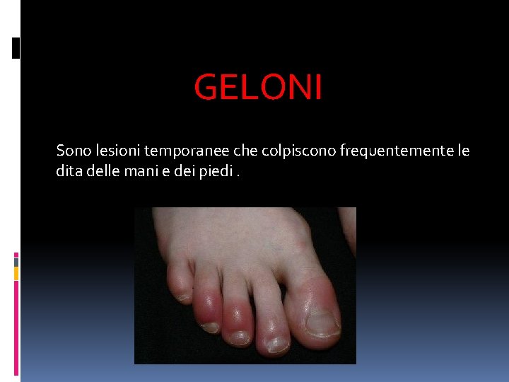  GELONI Sono lesioni temporanee che colpiscono frequentemente le dita delle mani e dei