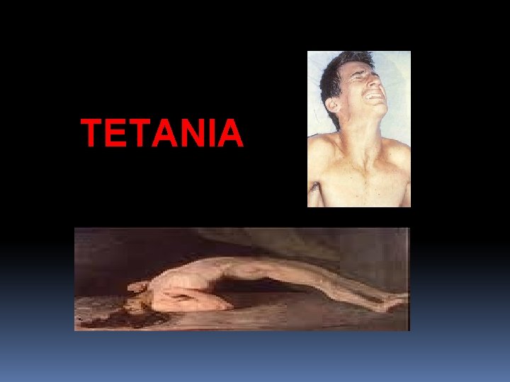 TETANIA 