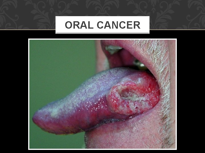 ORAL CANCER 