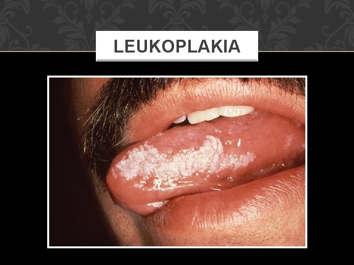 LEUKOPLAKIA 