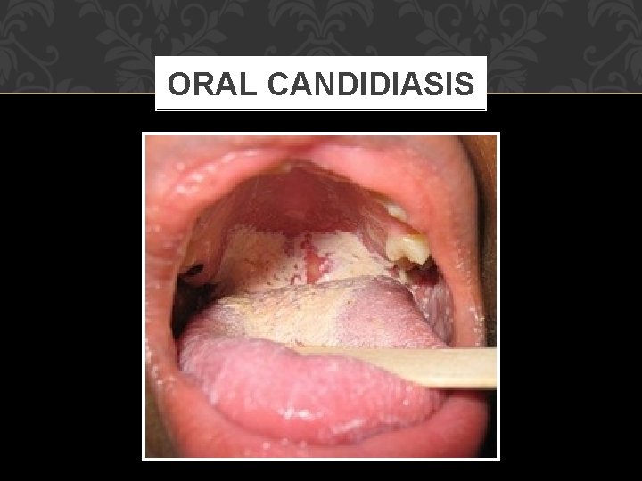 ORAL CANDIDIASIS 