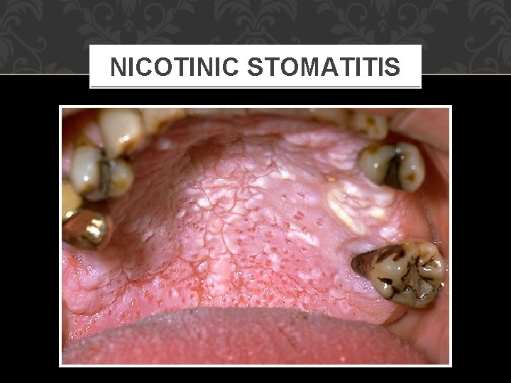 NICOTINIC STOMATITIS 