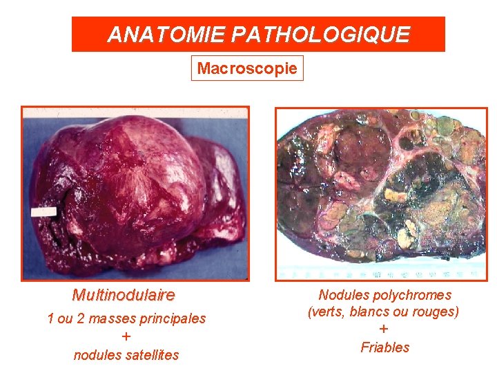 ANATOMIE PATHOLOGIQUE Macroscopie Multinodulaire 1 ou 2 masses principales + nodules satellites Nodules polychromes