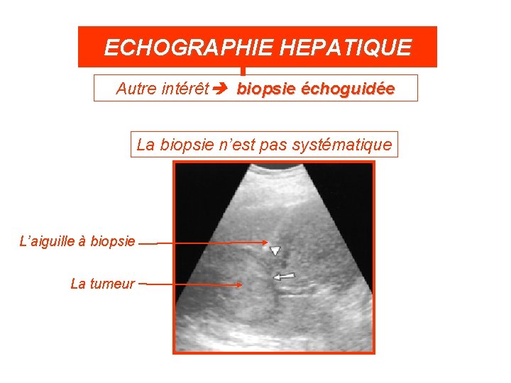 ECHOGRAPHIE HEPATIQUE Autre intérêt biopsie échoguidée La biopsie n’est pas systématique L’aiguille à biopsie