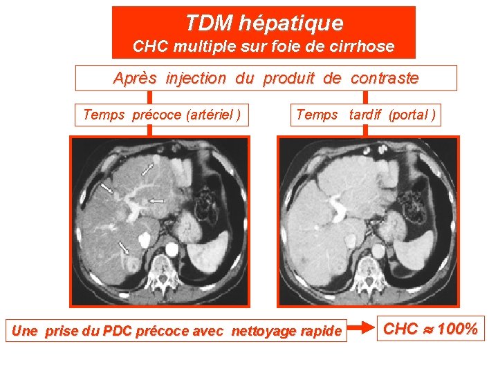 TDM hépatique CHC multiple sur foie de cirrhose Après injection du produit de contraste