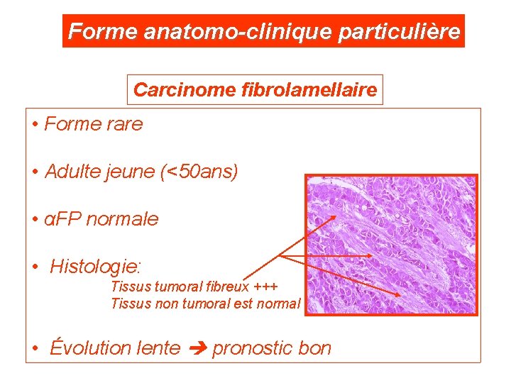 Forme anatomo-clinique particulière Carcinome fibrolamellaire • Forme rare • Adulte jeune (<50 ans) •