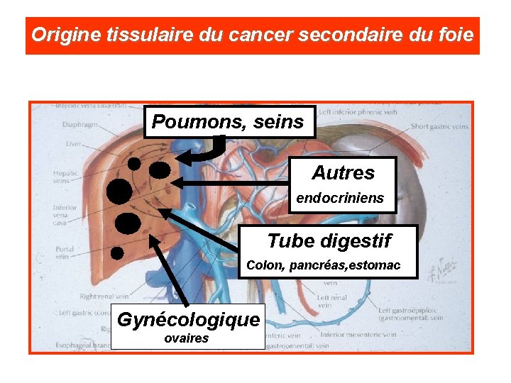 Origine tissulaire du cancer secondaire du foie Poumons, seins Autres endocriniens Tube digestif Colon,