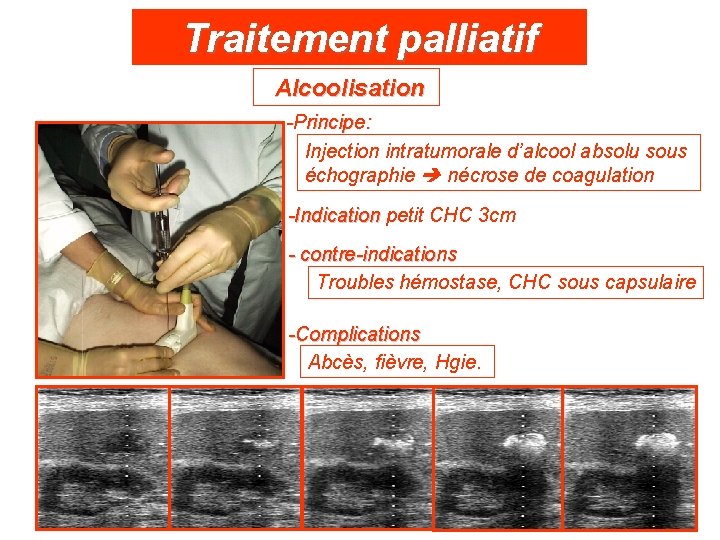Traitement palliatif Alcoolisation -Principe: Injection intratumorale d’alcool absolu sous échographie nécrose de coagulation -Indication