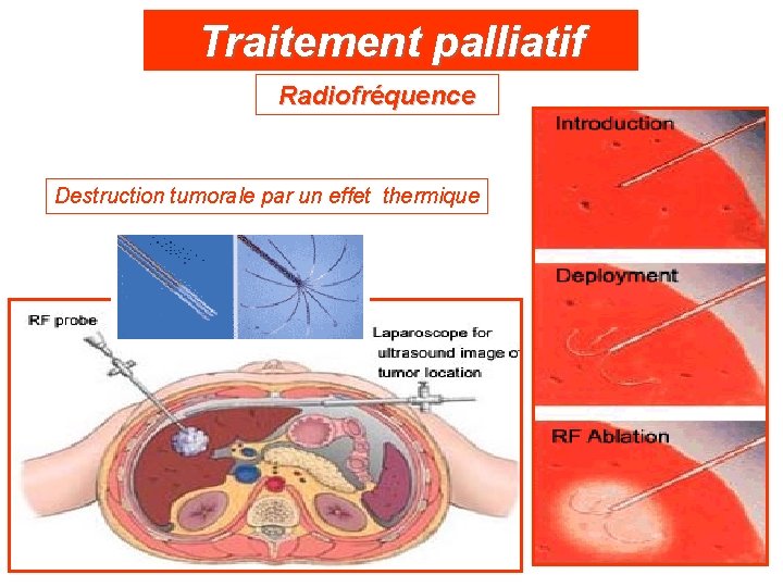 Traitement palliatif Radiofréquence Destruction tumorale par un effet thermique 