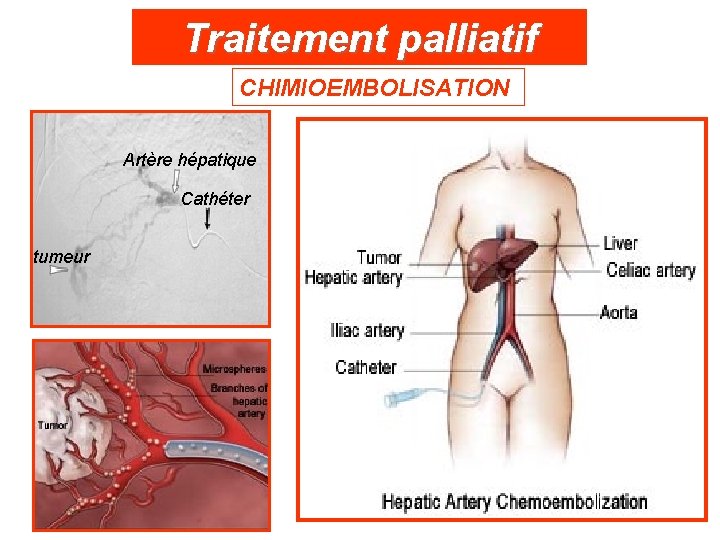 Traitement palliatif CHIMIOEMBOLISATION Artère hépatique Cathéter tumeur 