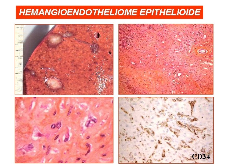 HEMANGIOENDOTHELIOME EPITHELIOIDE CD 34 