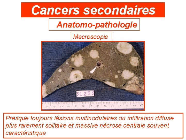 Cancers secondaires Anatomo-pathologie Macroscopie Presque toujours lésions multinodulaires ou infiltration diffuse plus rarement solitaire