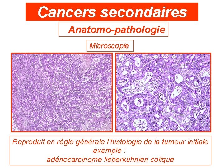 Cancers secondaires Anatomo-pathologie Microscopie Reproduit en règle générale l’histologie de la tumeur initiale exemple