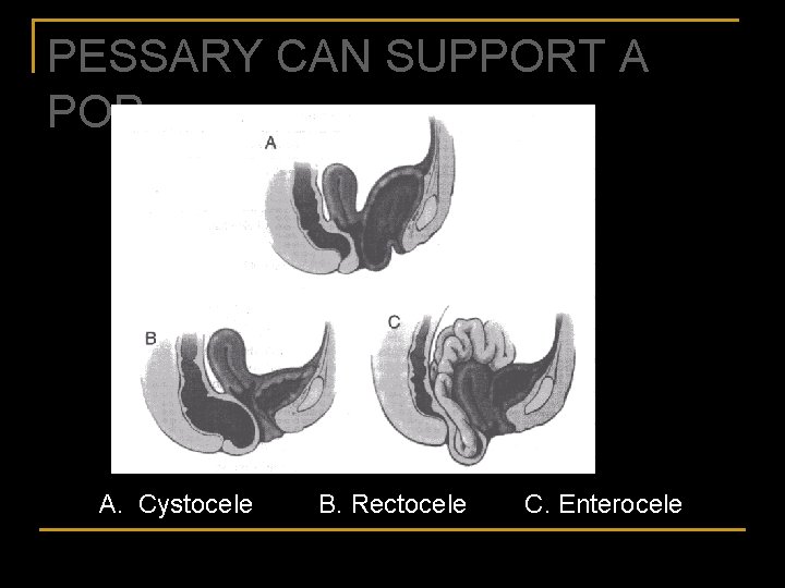PESSARY CAN SUPPORT A POP A. Cystocele B. Rectocele C. Enterocele 