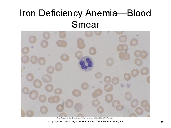 Iron Deficiency Anemia—Blood Smear • Copyright © 2014, 2011, 2006 by Saunders, an imprint