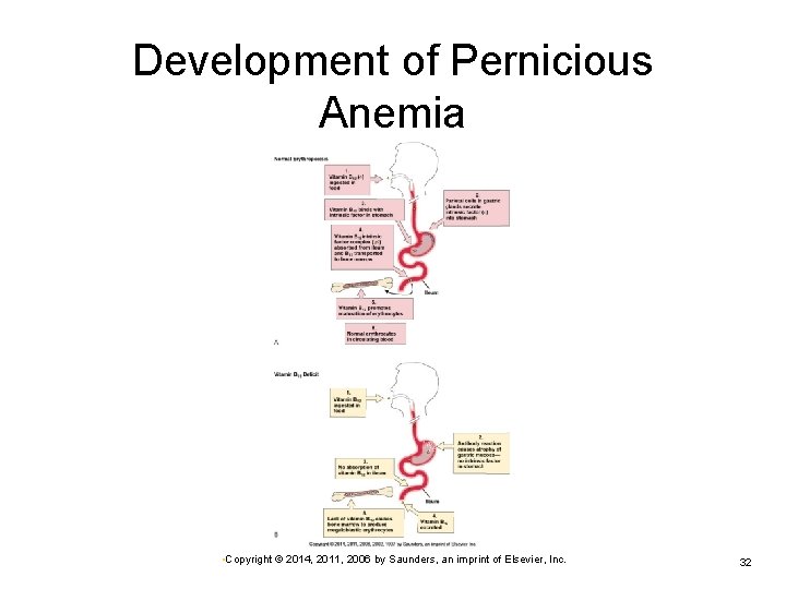 Development of Pernicious Anemia • Copyright © 2014, 2011, 2006 by Saunders, an imprint