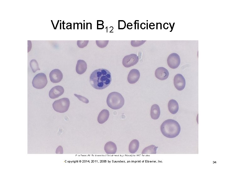 Vitamin B 12 Deficiency • Copyright © 2014, 2011, 2006 by Saunders, an imprint