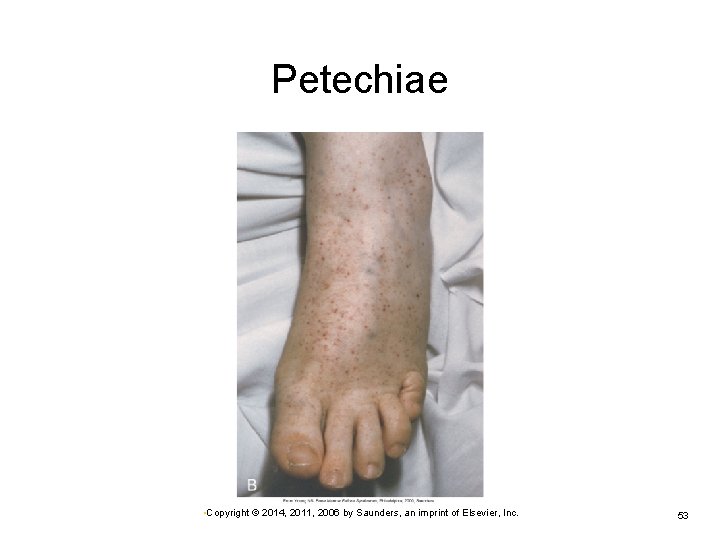 Petechiae • Copyright © 2014, 2011, 2006 by Saunders, an imprint of Elsevier, Inc.