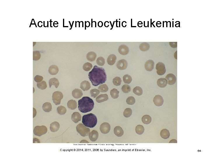 Acute Lymphocytic Leukemia • Copyright © 2014, 2011, 2006 by Saunders, an imprint of