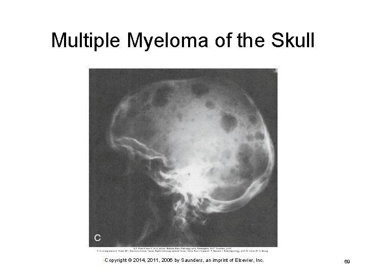 Multiple Myeloma of the Skull • Copyright © 2014, 2011, 2006 by Saunders, an