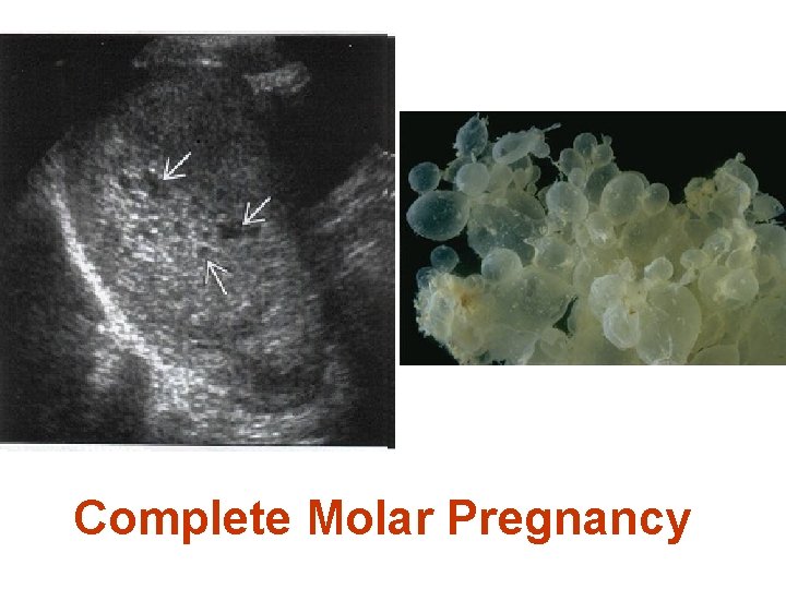 Complete Molar Pregnancy 