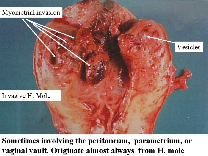 Myometrial invasion Vesicles Invasive H. Mole Sometimes involving the peritoneum, parametrium, or vaginal vault.