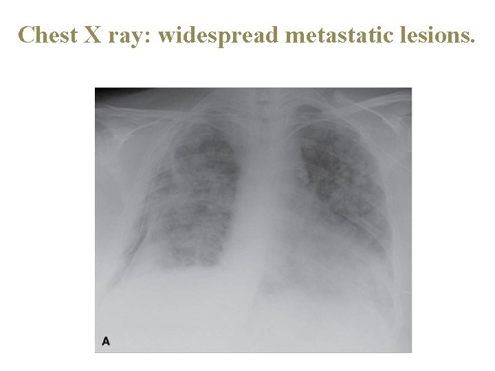 Chest X ray: widespread metastatic lesions. 