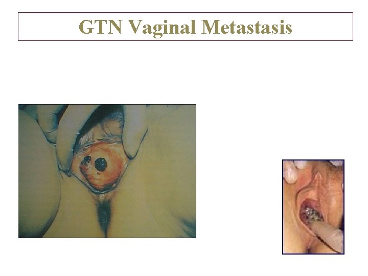 GTN Vaginal Metastasis 