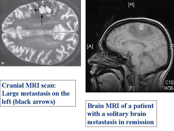 Cranial MRI scan: Large metastasis on the left (black arrows) Brain MRI of a