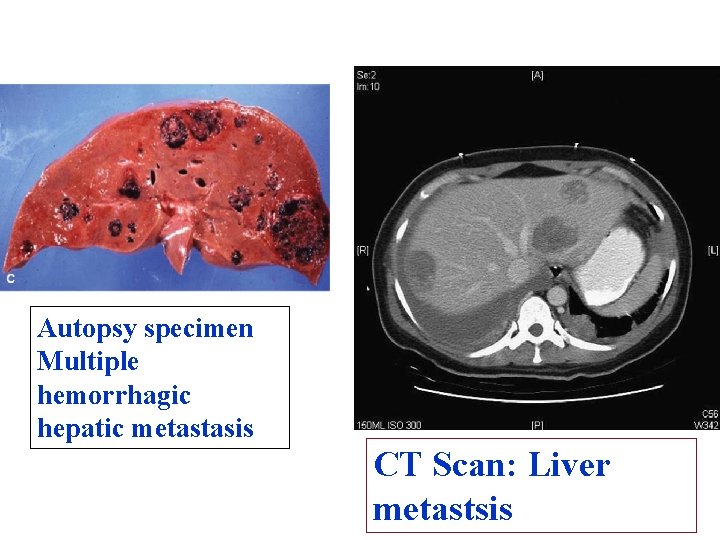 Autopsy specimen Multiple hemorrhagic hepatic metastasis CT Scan: Liver metastsis 