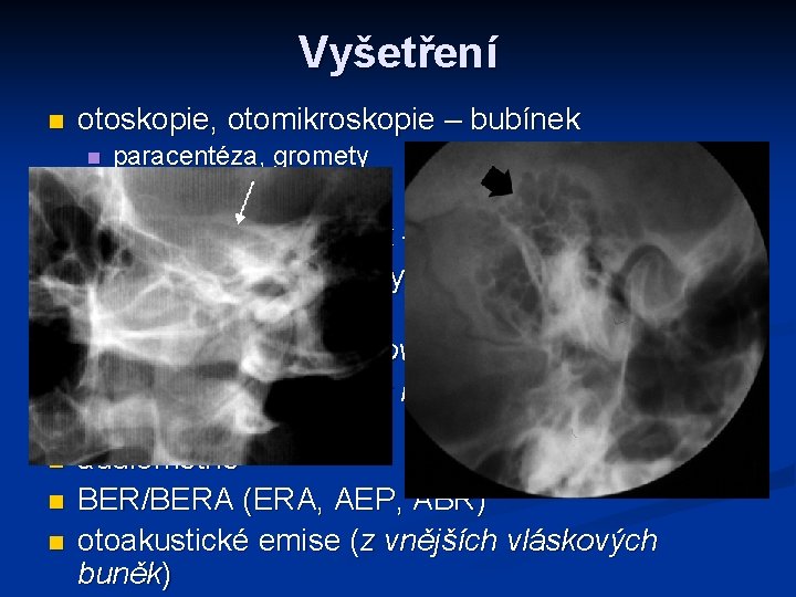 Vyšetření n otoskopie, otomikroskopie – bubínek n n n n paracentéza, gromety ladičkové zkoušky