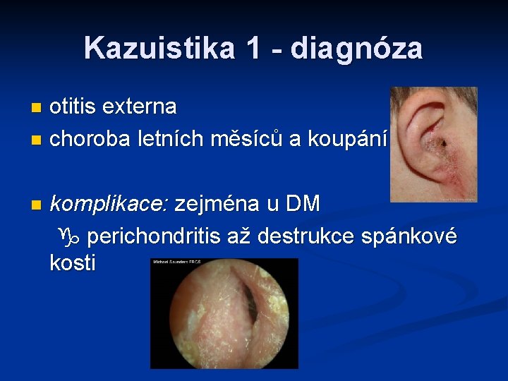 Kazuistika 1 - diagnóza otitis externa n choroba letních měsíců a koupání n n