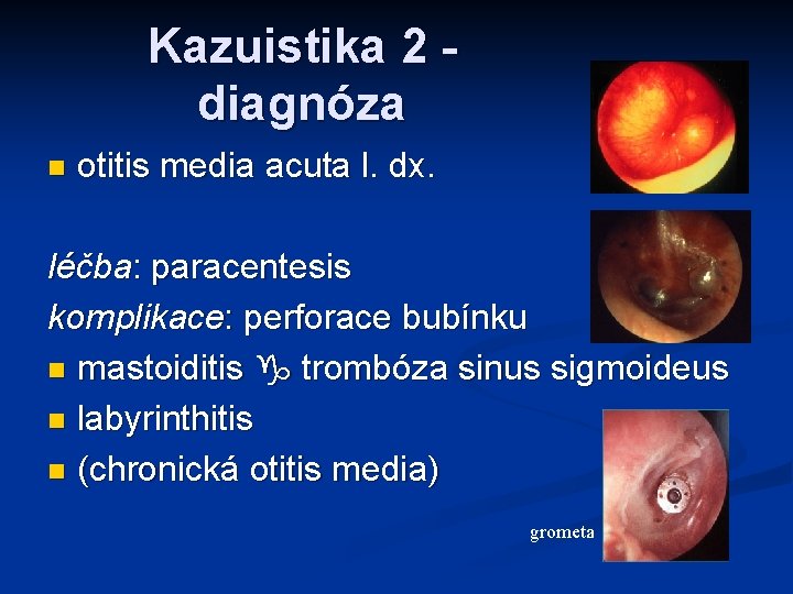 Kazuistika 2 diagnóza n otitis media acuta l. dx. léčba: paracentesis komplikace: perforace bubínku