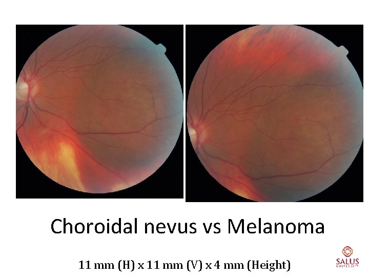 Choroidal nevus vs Melanoma 11 mm (H) x 11 mm (V) x 4 mm