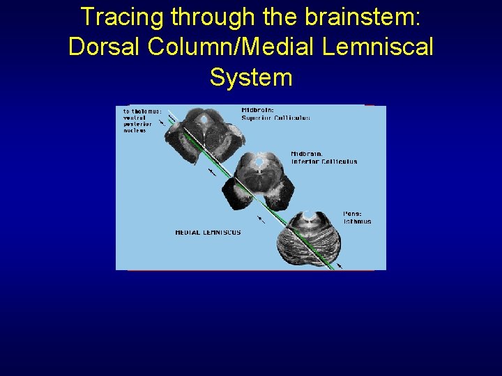 Tracing through the brainstem: Dorsal Column/Medial Lemniscal System 