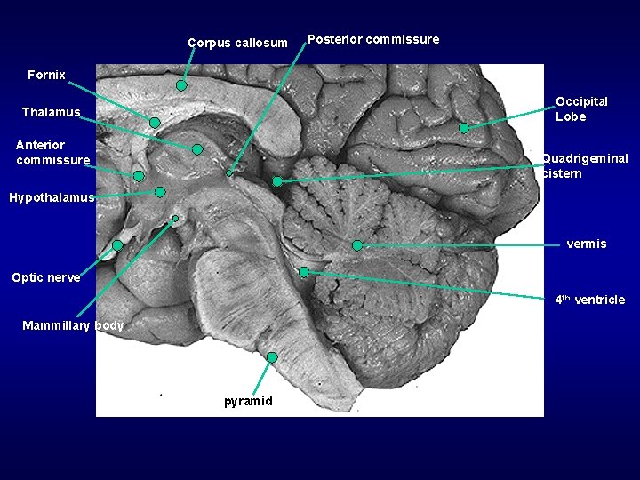 Corpus callosum Posterior commissure Fornix Occipital Lobe Thalamus Anterior commissure Quadrigeminal cistern Hypothalamus vermis