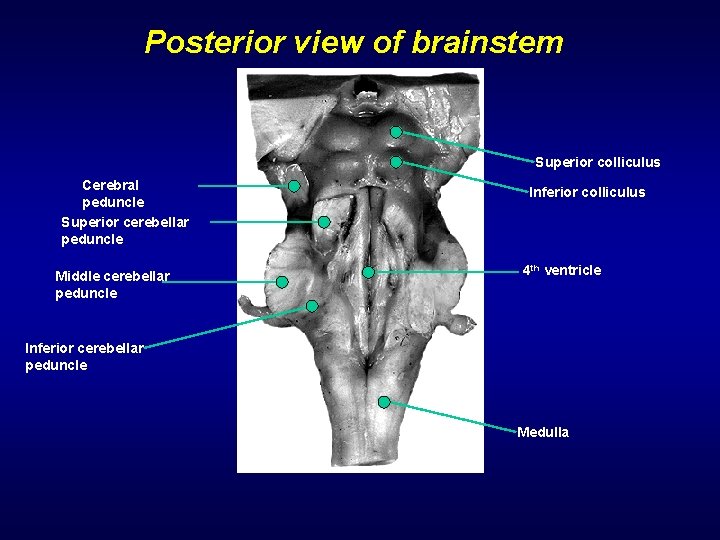 Posterior view of brainstem Superior colliculus Cerebral peduncle Superior cerebellar peduncle Middle cerebellar peduncle
